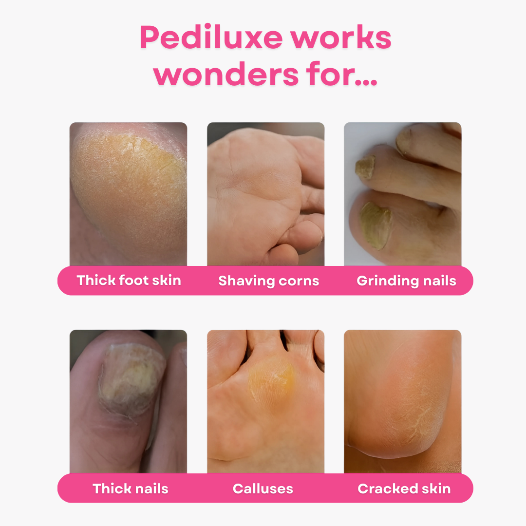 Nova Glo Series 3 - Callus Remover